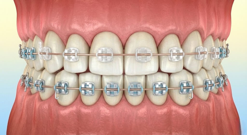 Керамические брекеты на верхней челюсти и сапфировые на нижней